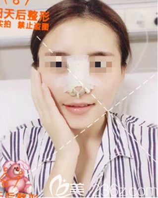 肋軟骨隆鼻第二天 肋軟骨隆鼻第二天
