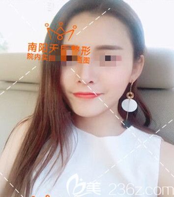 肋軟骨隆鼻一個(gè)月恢復(fù) 肋軟骨隆鼻一個(gè)月恢復(fù)