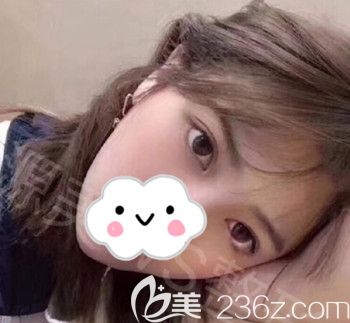 天生雙眼皮一定比割的好看 我做眼綜合后的切身體會(huì)告訴你那可不一定