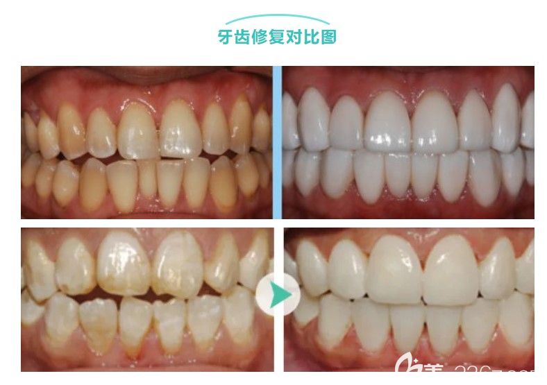 牙齒貼面的費(fèi)用