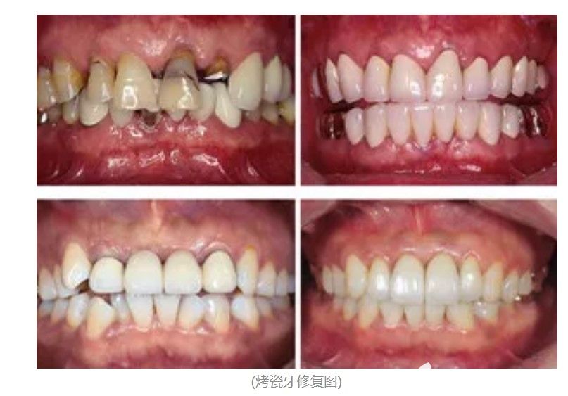 烤瓷牙的價(jià)格