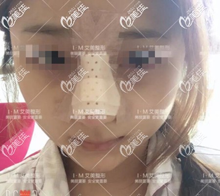 鼻綜合術后第二天