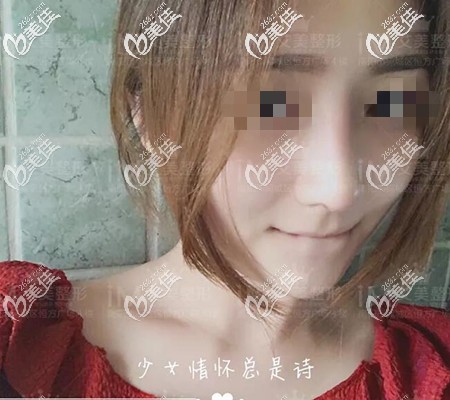 雖然鼻綜合恢復(fù)期很痛苦，但7天拆線后的隆鼻變化真的美到我了