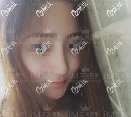 鼻綜合術后半年恢復效果