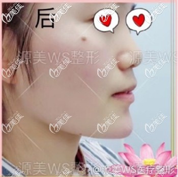 微整初體驗(yàn)：用2支海薇大分子玻尿酸豐下巴后從當(dāng)天的圖片中就能看出變化