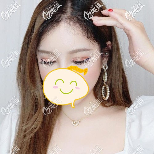 在廣州種完發(fā)際線我特別擔心脫落期不長頭發(fā)，誰知道植發(fā)后四個半月頭發(fā)就開始大量生長了