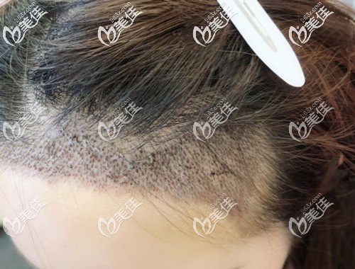 發(fā)際線剛種上去的毛囊 發(fā)際線剛種上去的毛囊