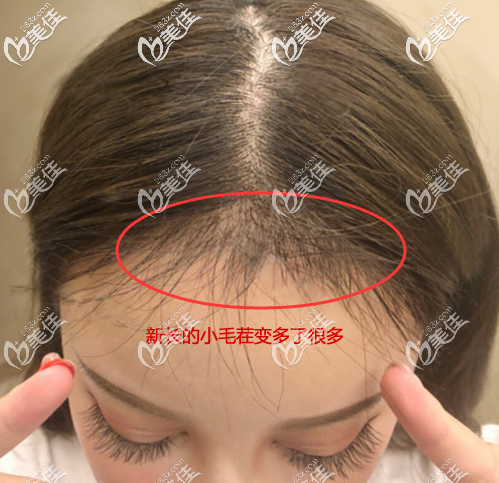 植發(fā)際線4個月后的頭發(fā)長了很多 植發(fā)際線4個月后的頭發(fā)長了很多