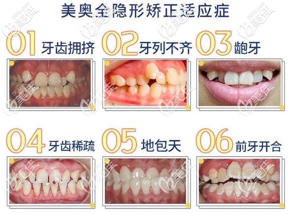 重慶美奧口腔全隱形牙齒矯正 重慶美奧口腔全隱形牙齒矯正