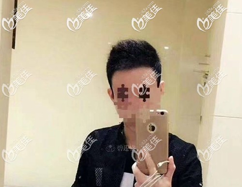 分享男士發(fā)際線種植過程(文中并講述了我植發(fā)這幾年的真實(shí)心得感受)