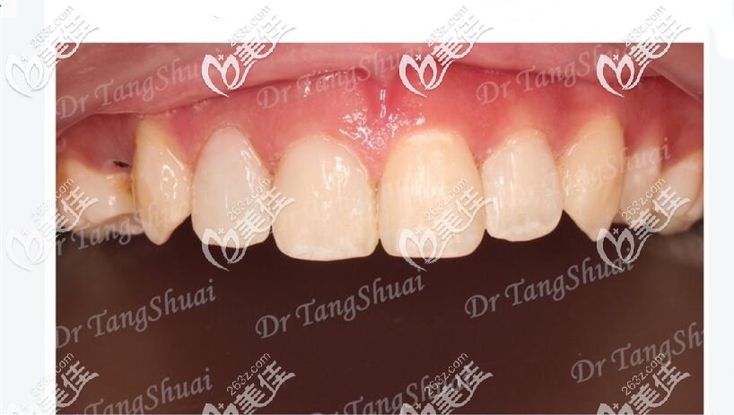 前牙美學(xué)樹脂修復(fù)案例