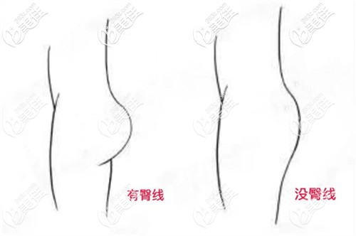 大腿吸脂后有臀線和沒有臀線的區(qū)別對比圖