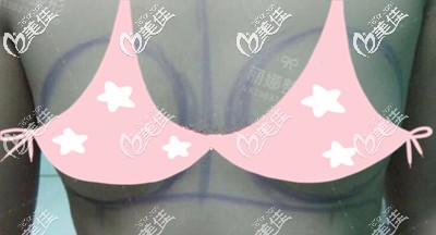 術(shù)前胸部扁平準(zhǔn)備做自體脂肪填充 術(shù)前胸部扁平準(zhǔn)備做自體脂肪填充