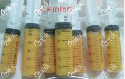 從大腿中抽取的脂肪填充到胸部 從大腿中抽取的脂肪填充到胸部