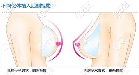 不同形狀隆胸假體材料的側視展現效果圖