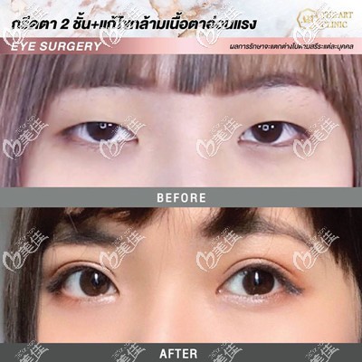 泰國割雙眼皮哪家醫(yī)院好？泰國藝術(shù)整形醫(yī)院雙眼皮真人案例圖