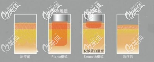 火鳳凰溶脂技術(shù)原理