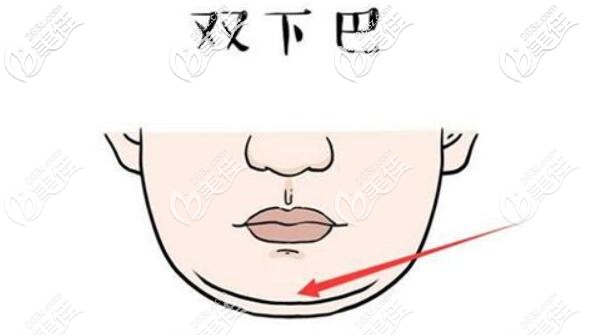 雙下巴的形成原因介紹