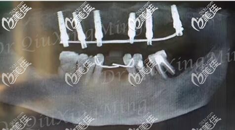 北京雅醫(yī)家邱星明all-on-6種植牙案例