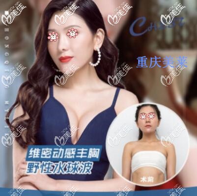 重慶美萊假體隆胸效果