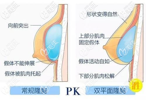 姜昌生采用內窺鏡雙平面隆胸術