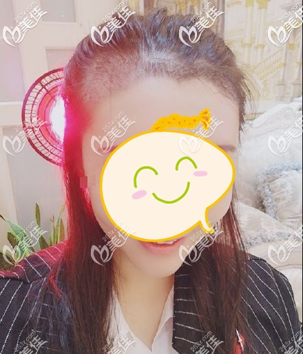 發(fā)際線種植一周效果圖