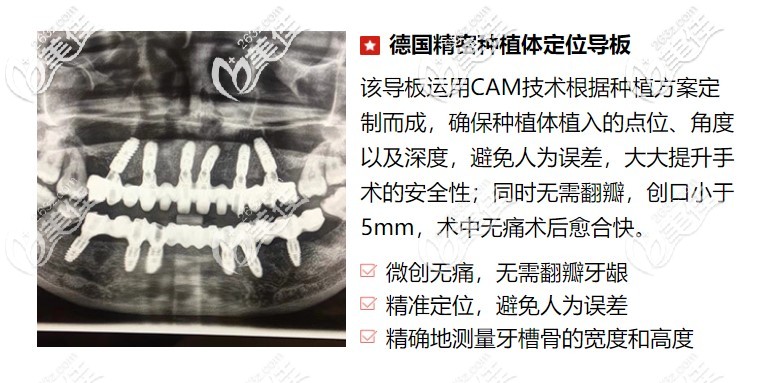 微創(chuàng)種植科的特色技術(shù)