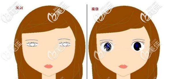 李成龍醫(yī)生的特色技術(shù)芭比翹睫美眼術(shù) 李成龍醫(yī)生的特色技術(shù)芭比翹睫美眼術(shù)