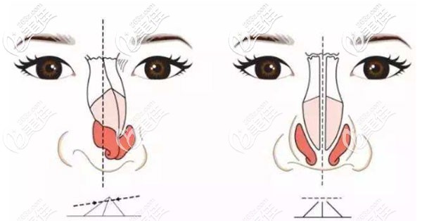 整形胡凱做鼻子多少錢 整形胡凱做鼻子多少錢
