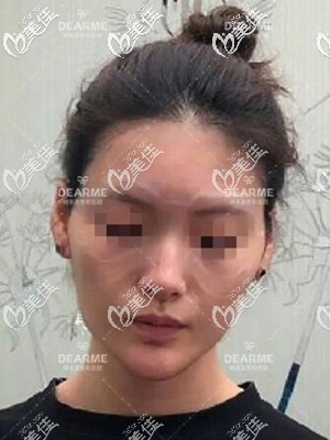 脂肪填充術(shù)前