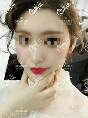 不知道顴骨高是磨骨還是脂肪填充好的戳進(jìn)來看案例對比照選擇適合你的