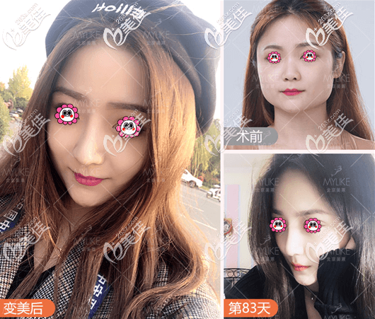 北京美萊<!--<i data=20240703-sp></i>-->醫(yī)生耳軟骨復(fù)合隆鼻 北京美萊<!--<i data=20240703-sp></i>-->醫(yī)生耳軟骨復(fù)合隆鼻