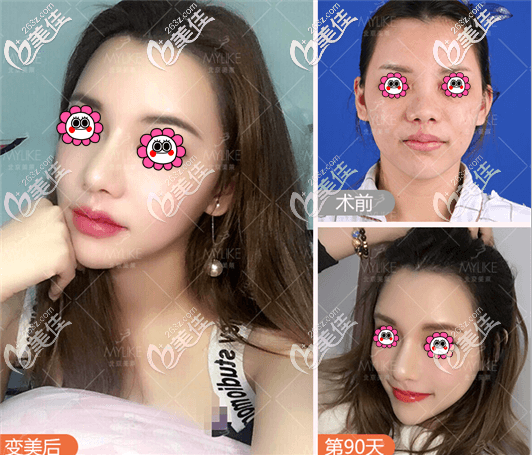 北京美萊<!--<i data=20240703-sp></i>-->醫(yī)生假體鼻綜合隆鼻 北京美萊<!--<i data=20240703-sp></i>-->醫(yī)生假體鼻綜合隆鼻