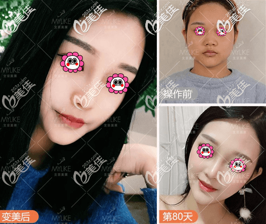 北京美萊葉醫(yī)生Dallas綜合隆鼻 北京美萊葉醫(yī)生Dallas綜合隆鼻