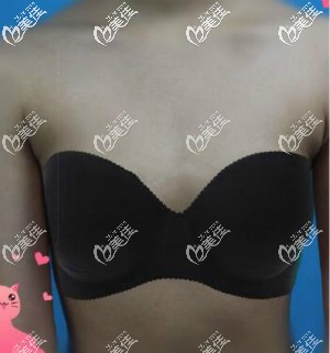 伊思雅假體隆胸術(shù)前