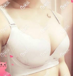 伊思雅假體隆胸術(shù)后效果