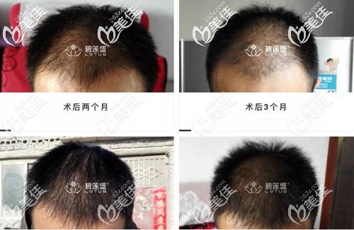 頭頂植發(fā)1到8個(gè)月效果圖