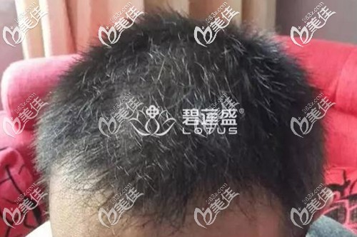 我由于雄性激素脫發(fā)時(shí)間較長(zhǎng)脫發(fā)等級(jí)已達(dá)5級(jí),所以只能靠前額頭頂植發(fā)治療了