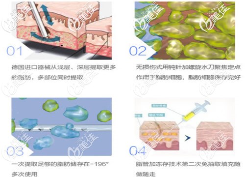 泉州脂管加自體脂肪抽吸過(guò)程圖 泉州脂管加自體脂肪抽吸過(guò)程圖