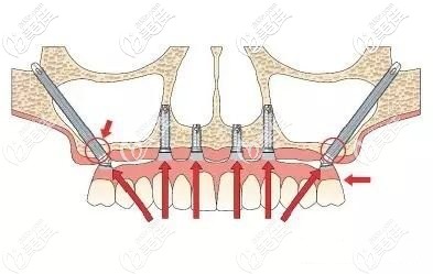 穿顴穿翼板種植牙