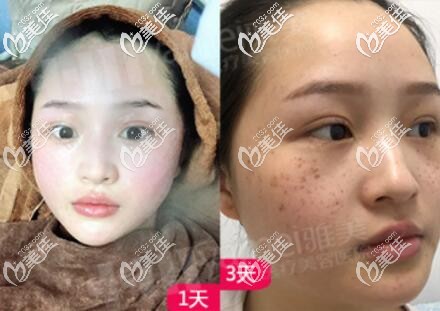 在雅美做皮秒激光祛斑術(shù)后效果照 在雅美做皮秒激光祛斑術(shù)后效果照