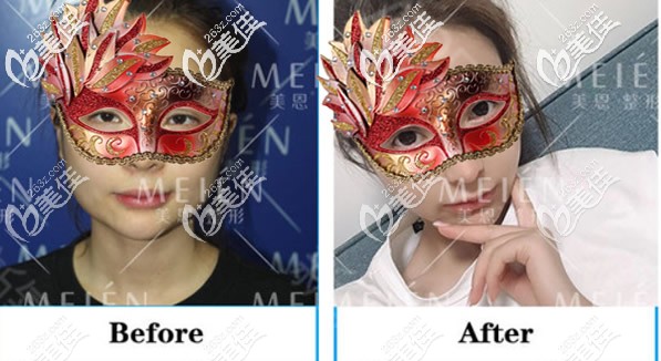 去頰脂墊真人恢復(fù)圖