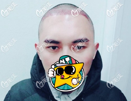 前額發(fā)際線調(diào)整手術(shù) 前額發(fā)際線調(diào)整手術(shù)