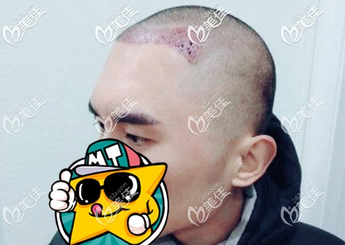 發(fā)際線下調(diào)種植即可效果圖 發(fā)際線下調(diào)種植即可效果圖