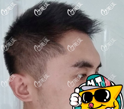 術(shù)后7個(gè)月頭頂長(zhǎng)出了頭發(fā) 術(shù)后7個(gè)月頭頂長(zhǎng)出了頭發(fā)