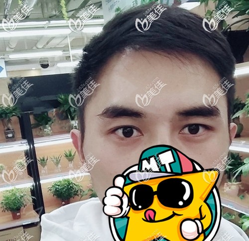 (我22歲男生)腦門(mén)禿發(fā)際線上移，做植發(fā)下調(diào)發(fā)際線后不再懼怕露額頭