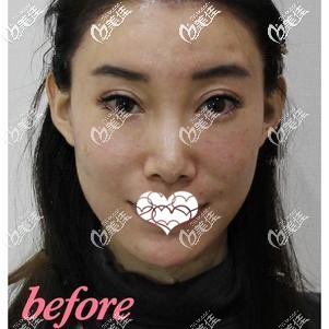 激光祛斑前黃褐斑較多 激光祛斑前黃褐斑較多