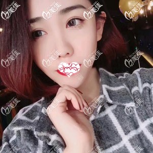 超皮秒祛斑術(shù)后15天面部皮膚變白凈 超皮秒祛斑術(shù)后15天面部皮膚變白凈