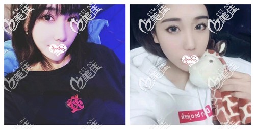 以我做超皮秒祛斑的真實經(jīng)歷來看激光去黃褐斑是否會反彈