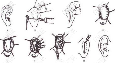 泰國圣卡洛整形醫(yī)院招風耳矯正效果怎么樣？